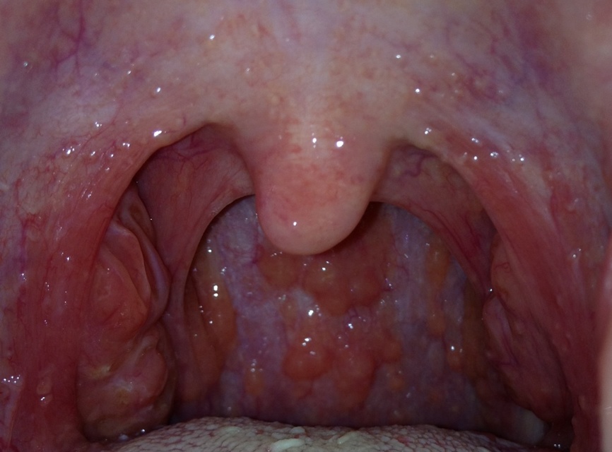 咽喉感覺有異物感但吞咽正常，原因、影響與處理方法，咽喉異物感解析，成因、影響及應(yīng)對(duì)之策