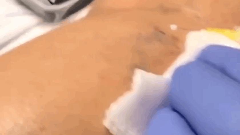 臉色紅血絲的根治方法，了解、預防與治療，臉色紅血絲的全方位解析，根治方法、預防與治療策略