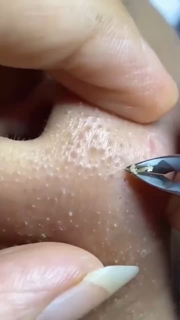 如何有效處理黑頭問(wèn)題——全方位解析黑頭成因與解決方案，全方位解析，黑頭成因探究與有效處理方案