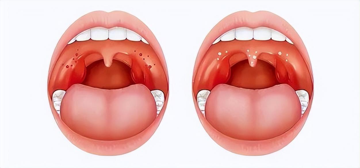 扁桃體腫大最好的治療方法，扁桃體腫大最佳治療方法探討